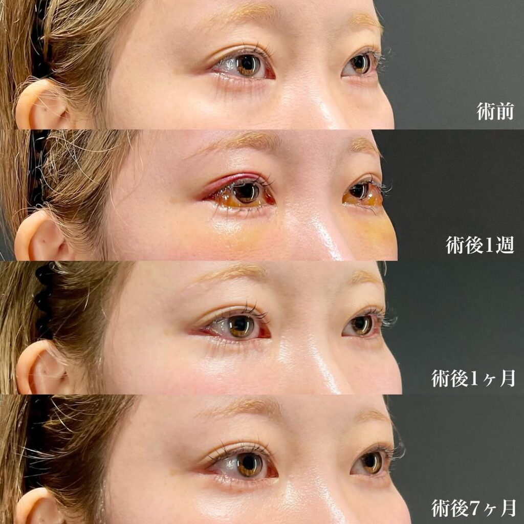 白目拡大術 他院修正