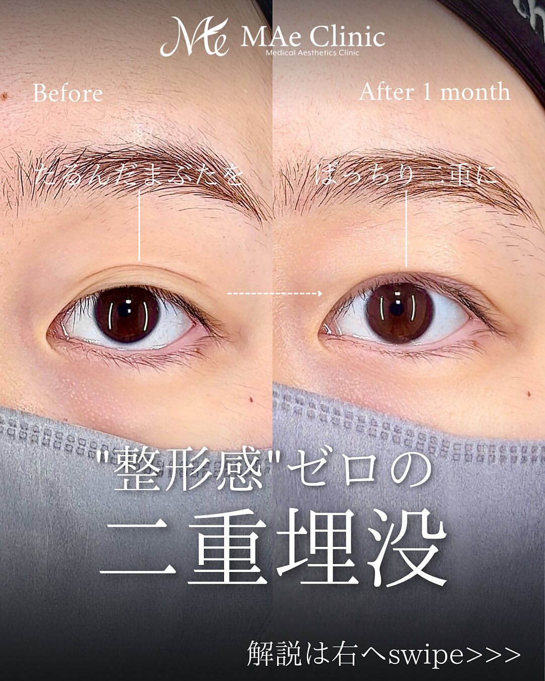 埋没症例紹介】左右差を整える二重デザインとは？｜眼瞼下垂とたるみを