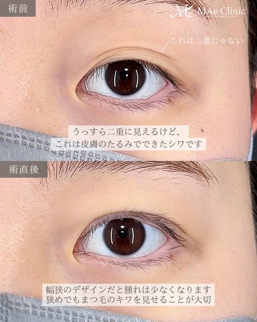 二重埋没症例
