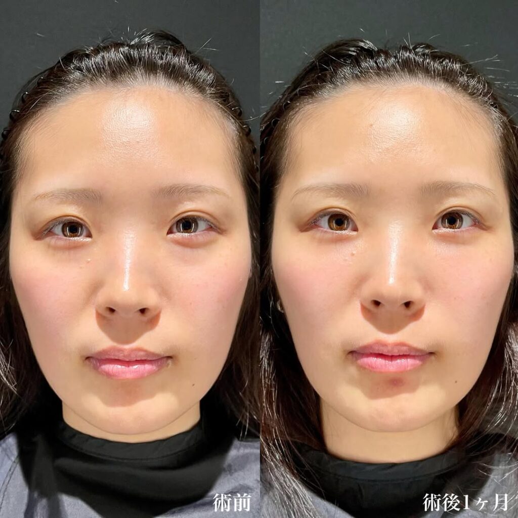 裏ハムラ症例