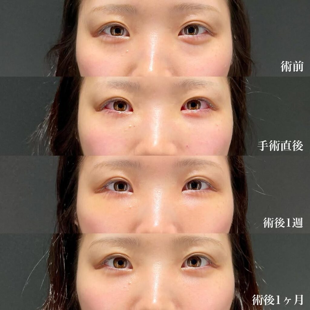 裏ハムラ症例
