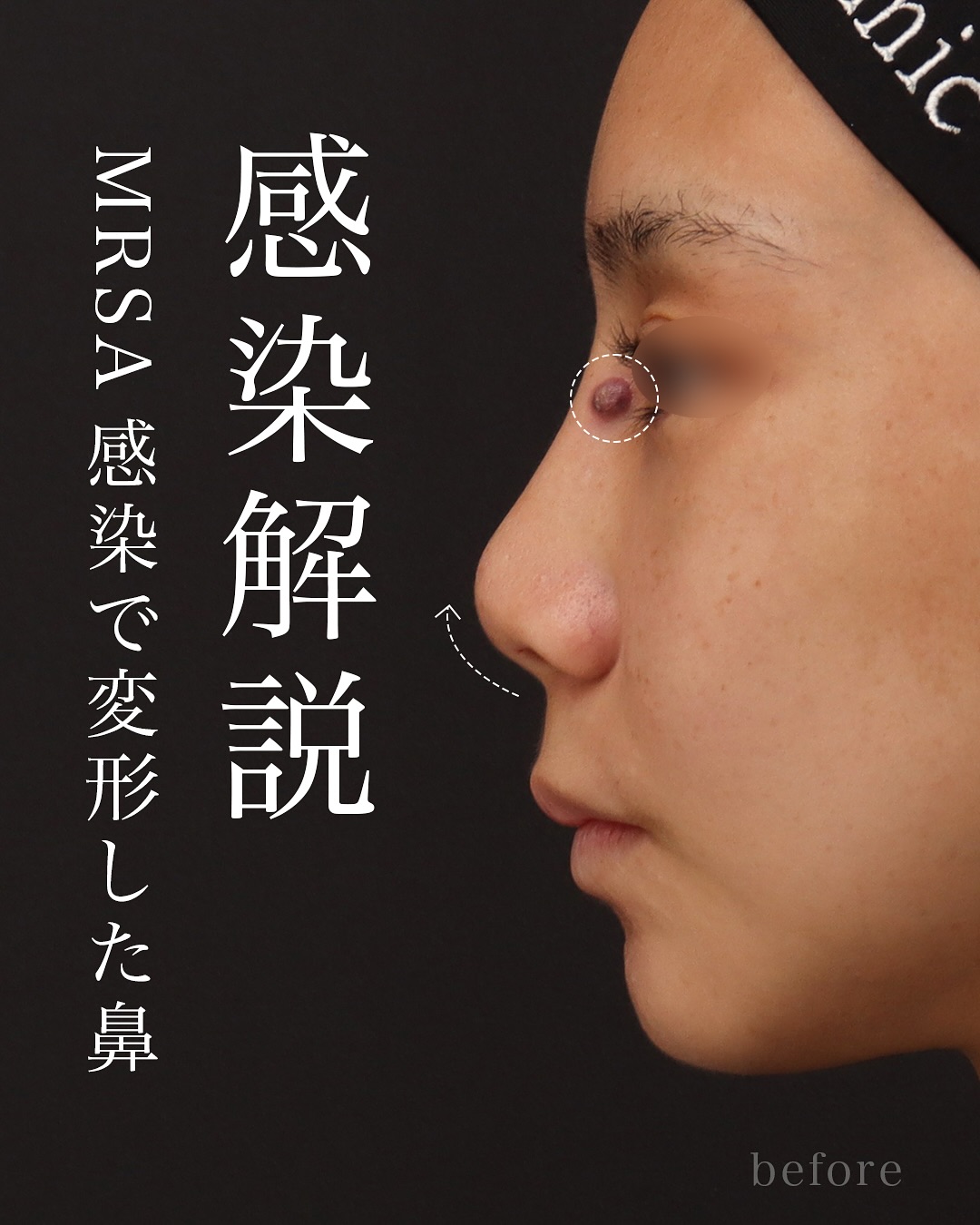 プロテーゼ感染からの再建｜MRSA感染を経て“自然な鼻筋”を取り戻した