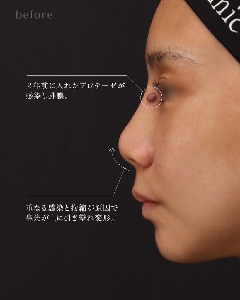 鼻整形　感染