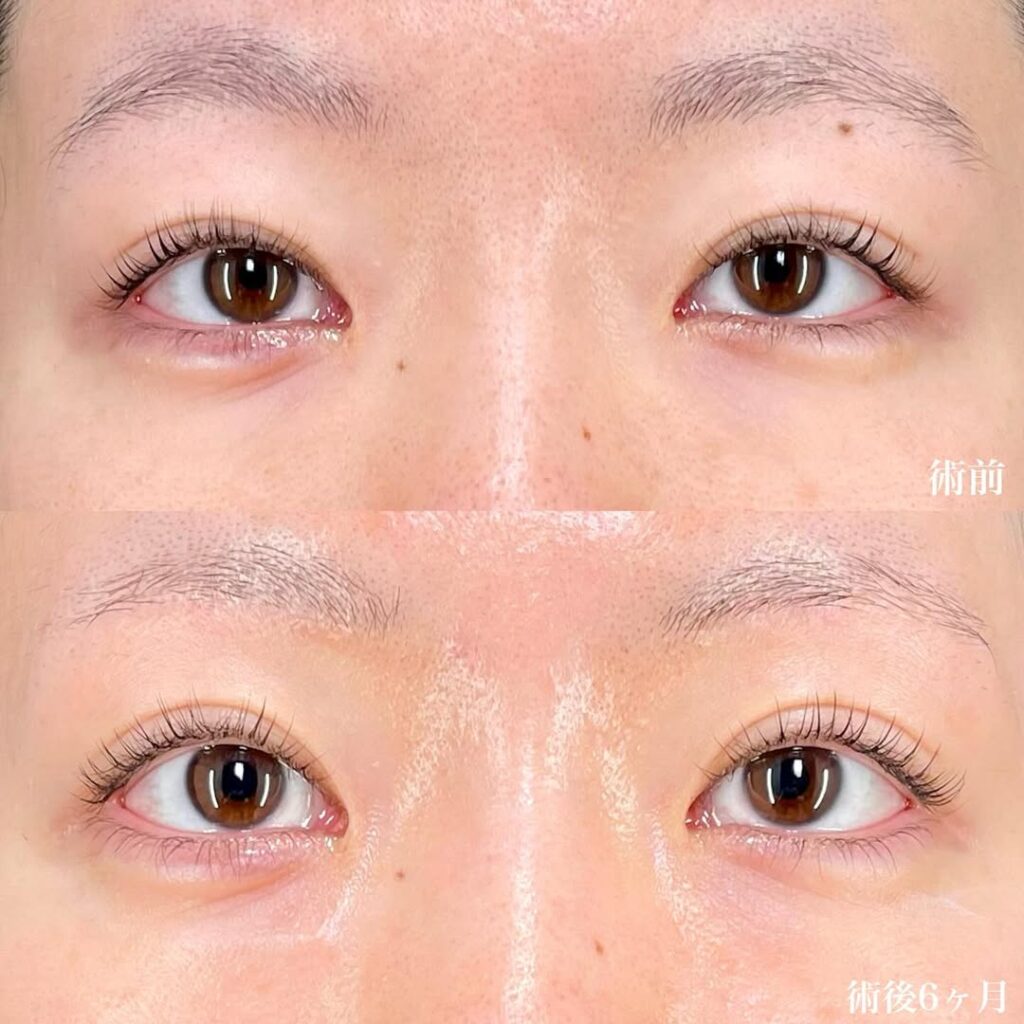 眉下切開 症例