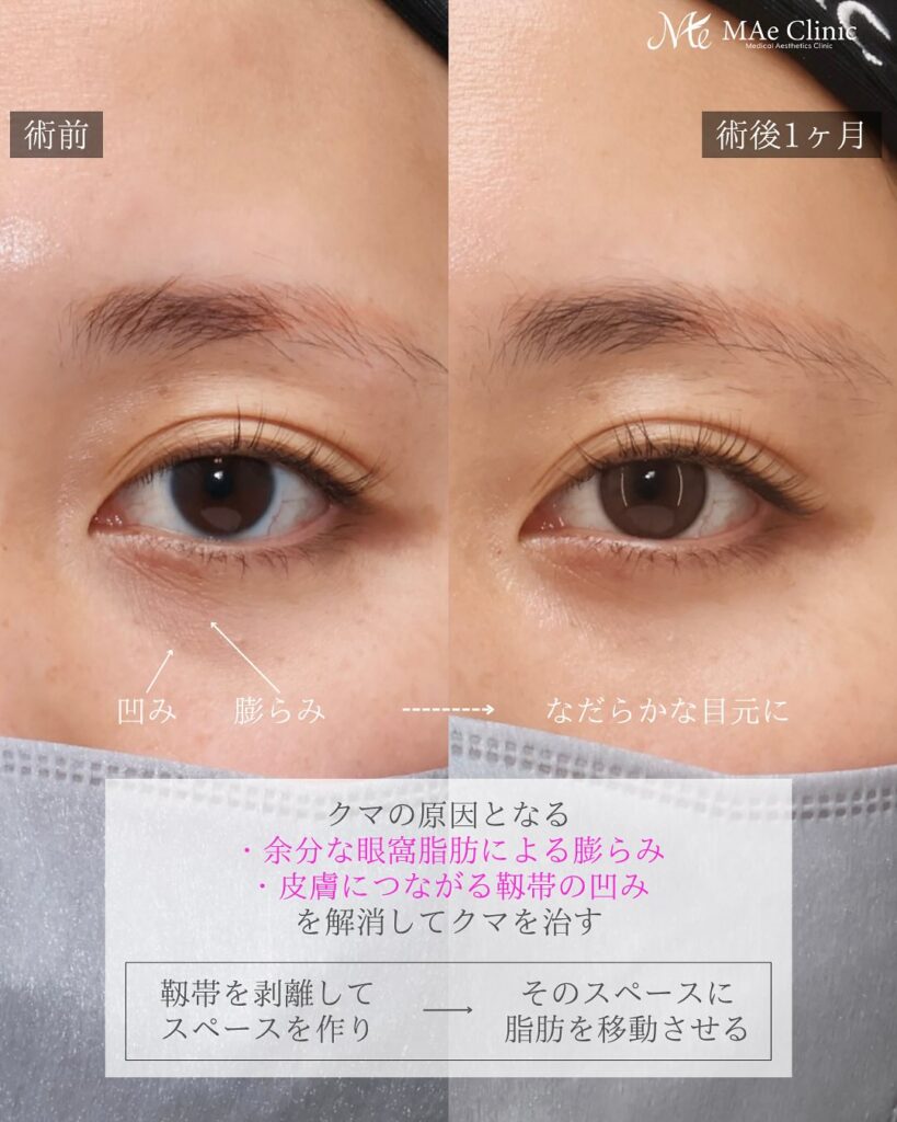 裏ハムラ症例