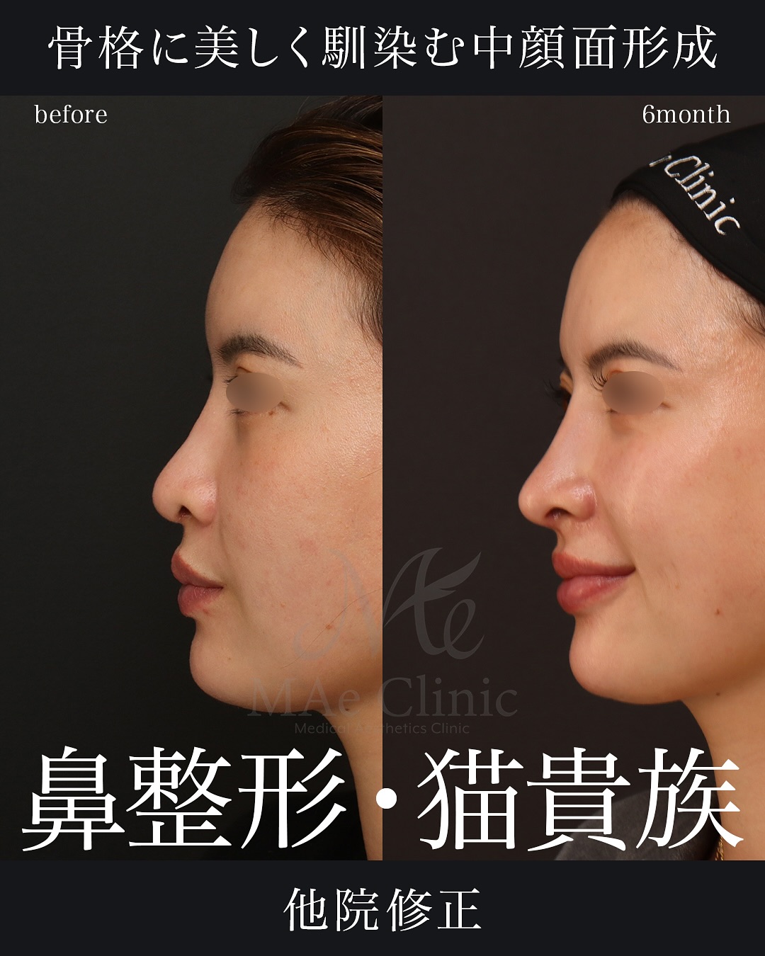 【裁断済み】外鼻形成術 機能と形態を両立した手術 2025061521.jpg