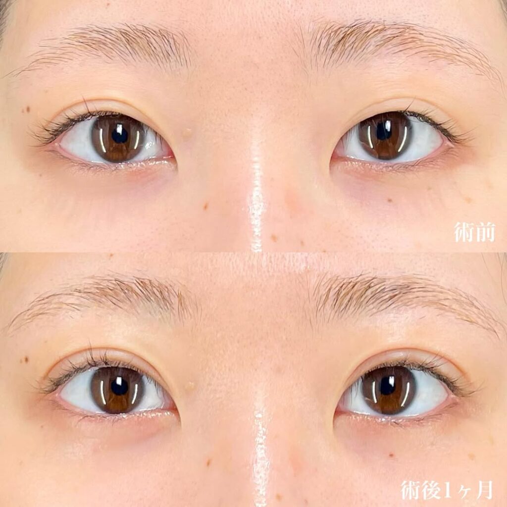 全切開二重 埋没二重 術後1ヶ月