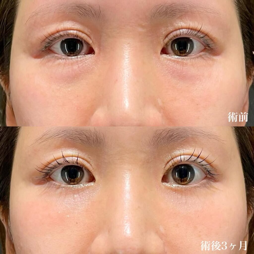 睫毛上皮膚切除(右目) 裏ハムラ 術後3ヶ月