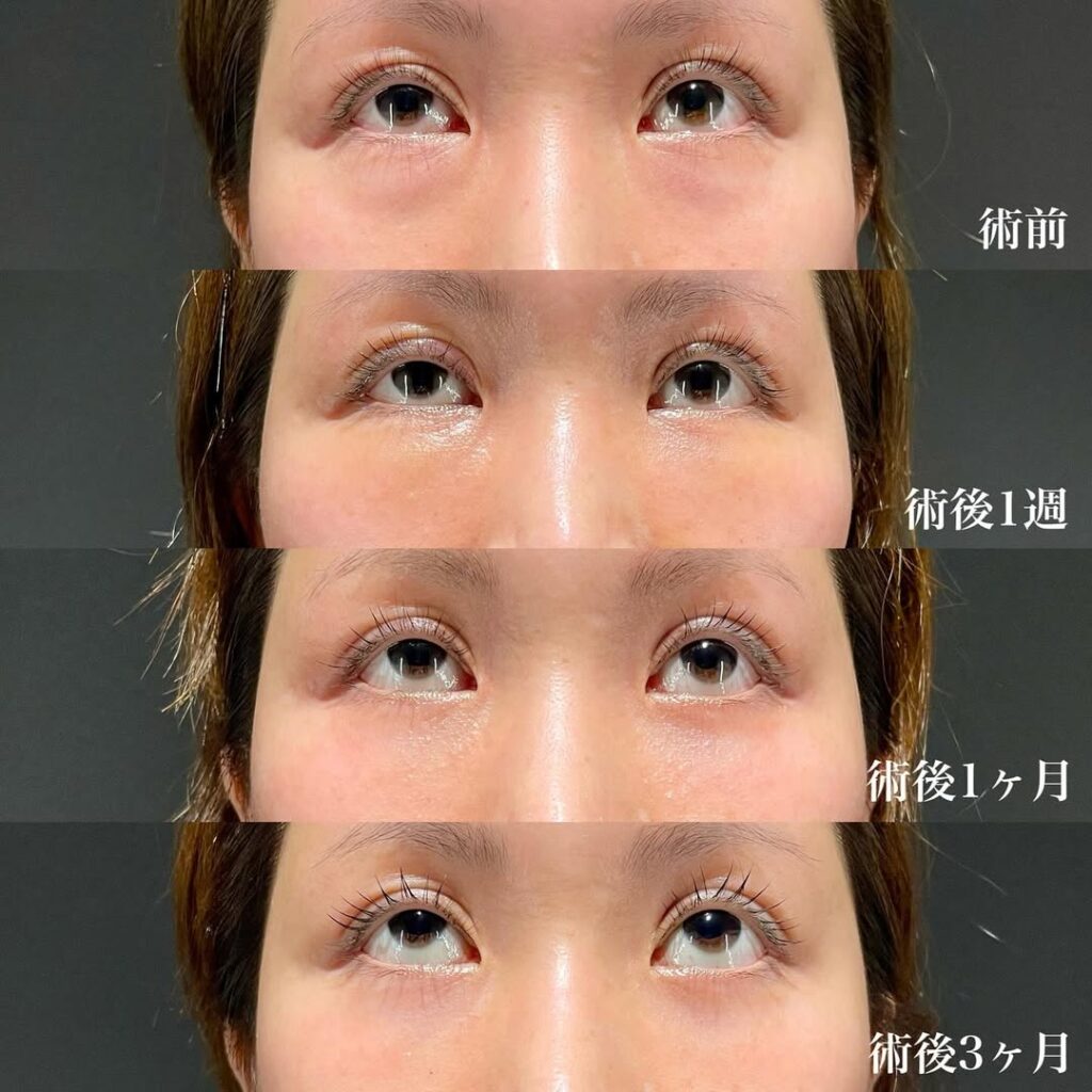 睫毛上皮膚切除(右目) 裏ハムラ 術後3ヶ月