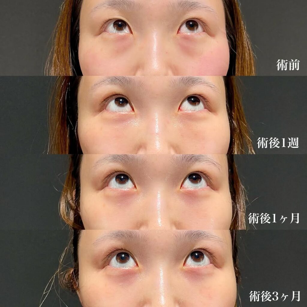裏ハムラ
二重埋没(右目のみ/裏留め2ループ)
術後3ヶ月