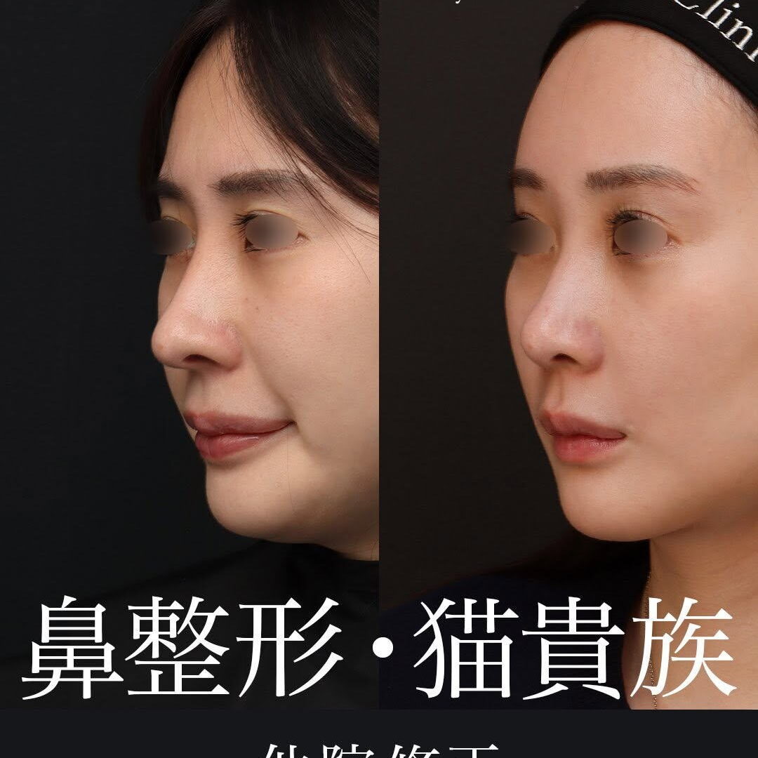 他院修正】高くしすぎた鼻をナチュラルなラインに再構築した症例（術後