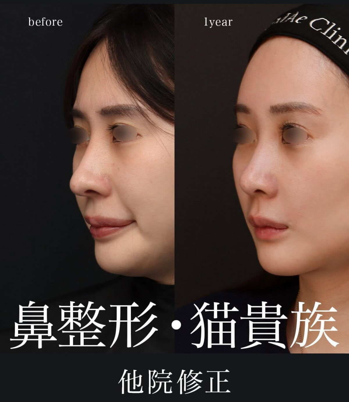 外鼻形成術 2025062524-1-1200x1380.jpg