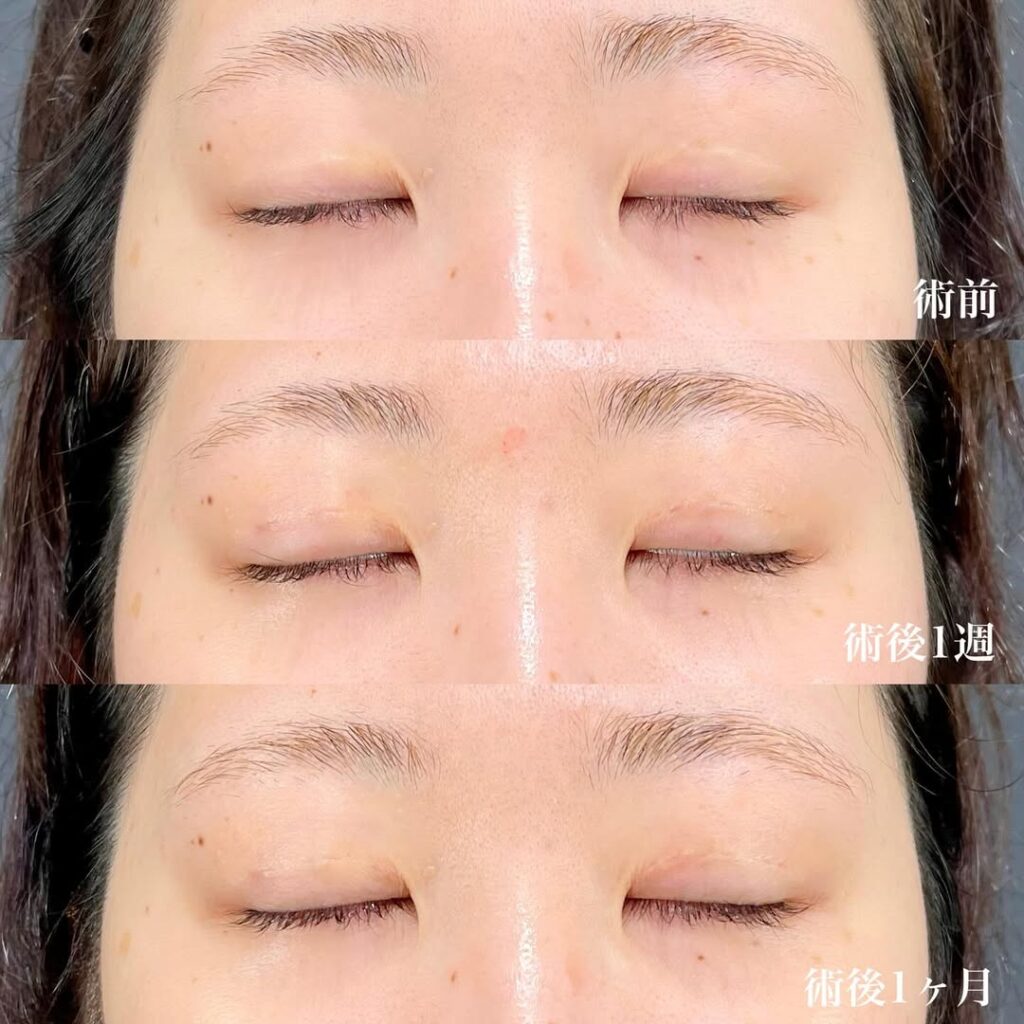 全切開二重 埋没二重 術後1ヶ月