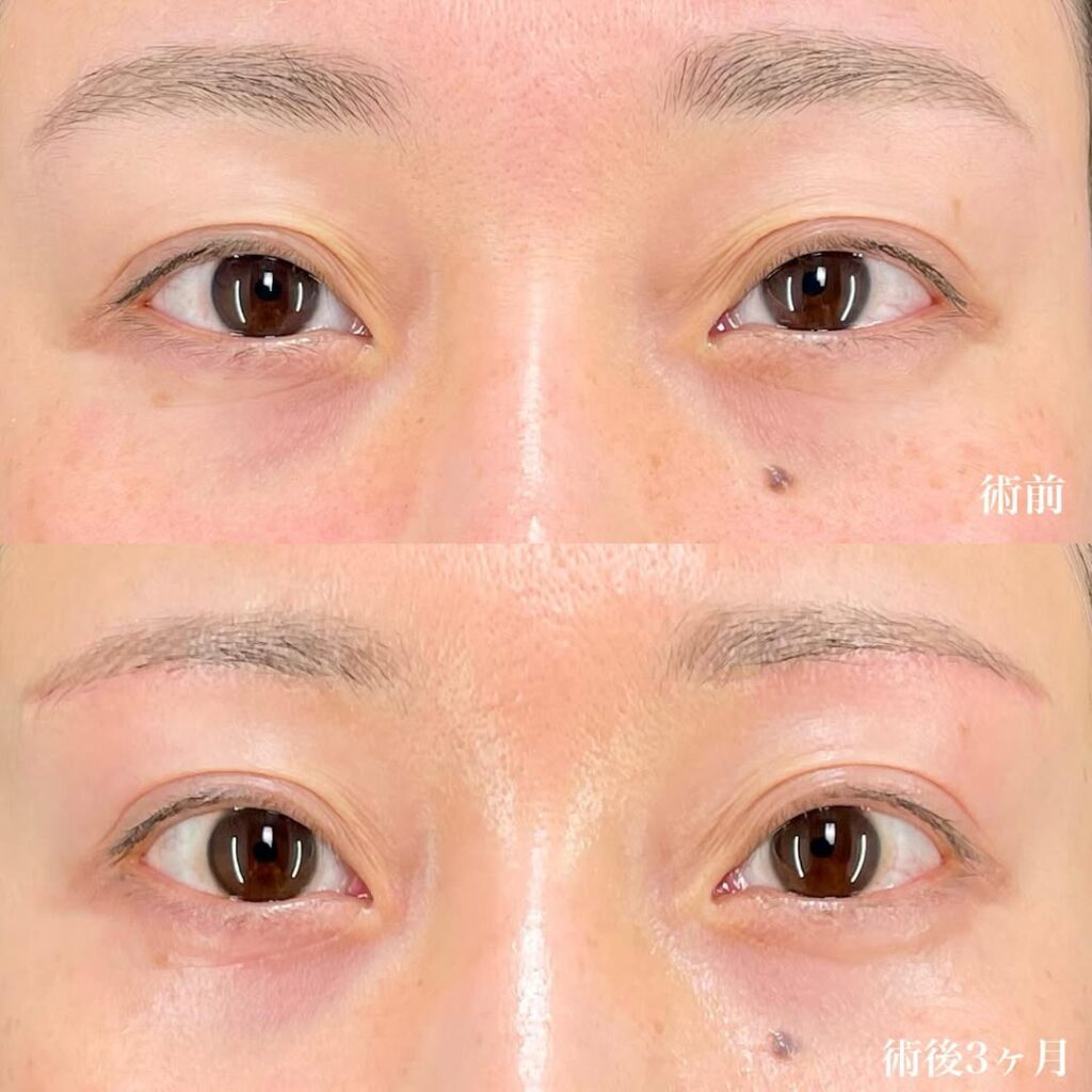 眉下切開