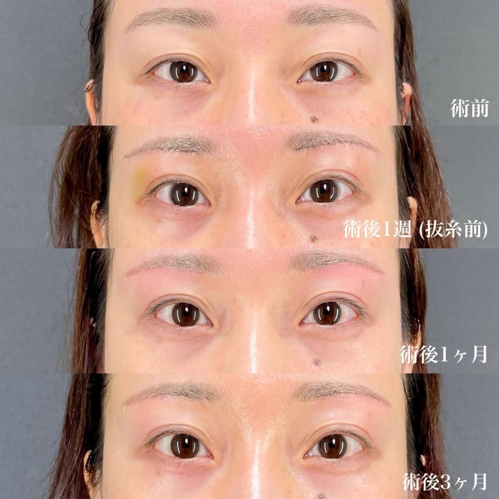 眉下切開