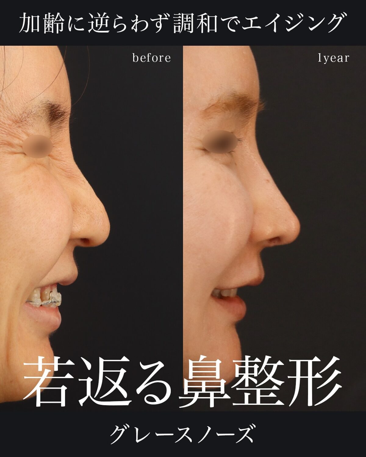 グレースノーズ症例】“魔女鼻”を整え、鼻から印象を若返らせる｜術後1