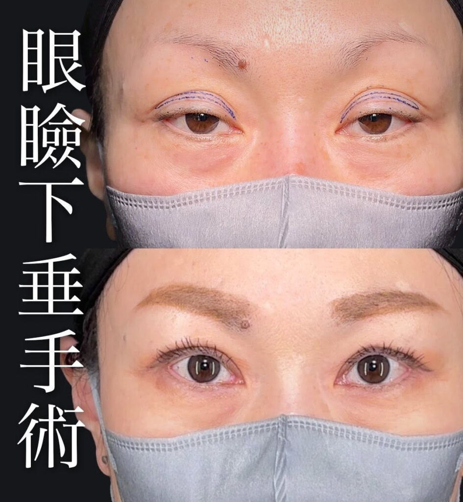 眼瞼下垂症例