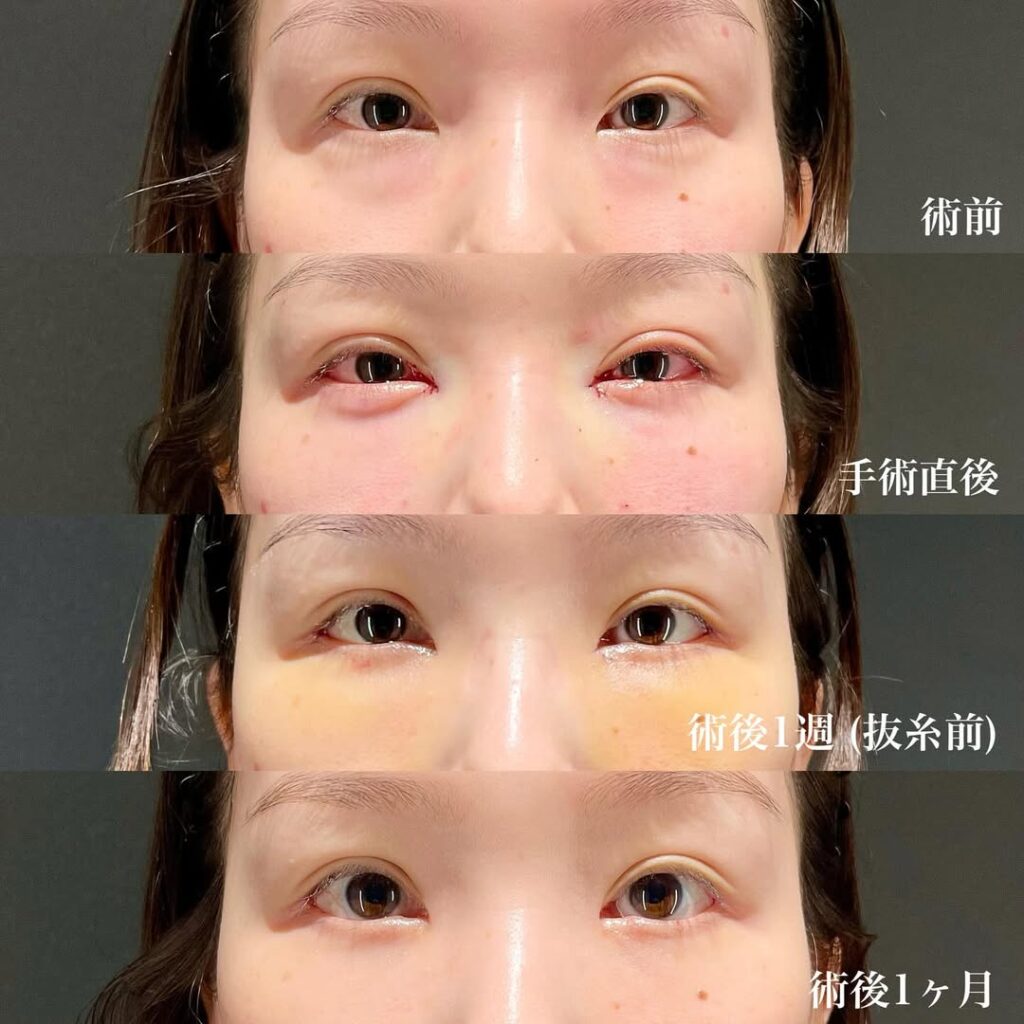 目頭切開 目尻切開 裏ハムラ 症例