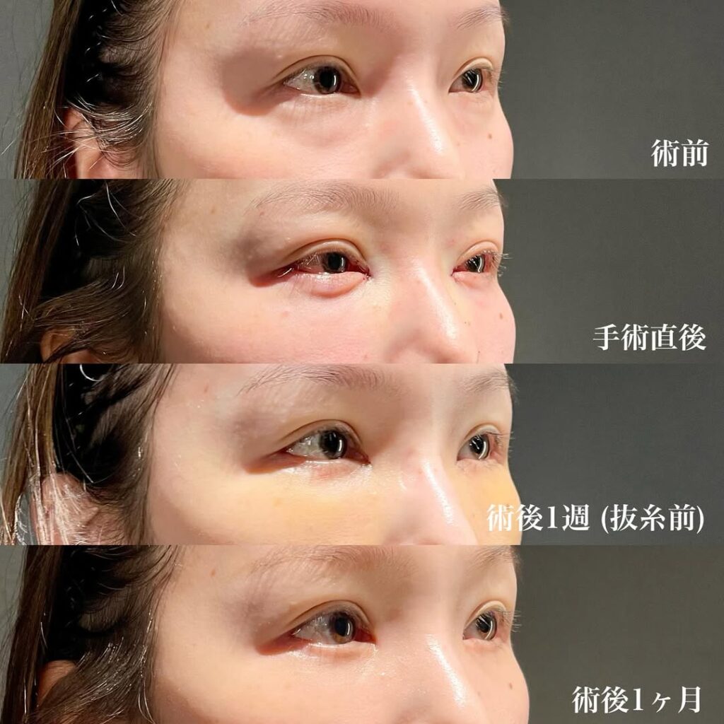 目頭切開 目尻切開 裏ハムラ 症例