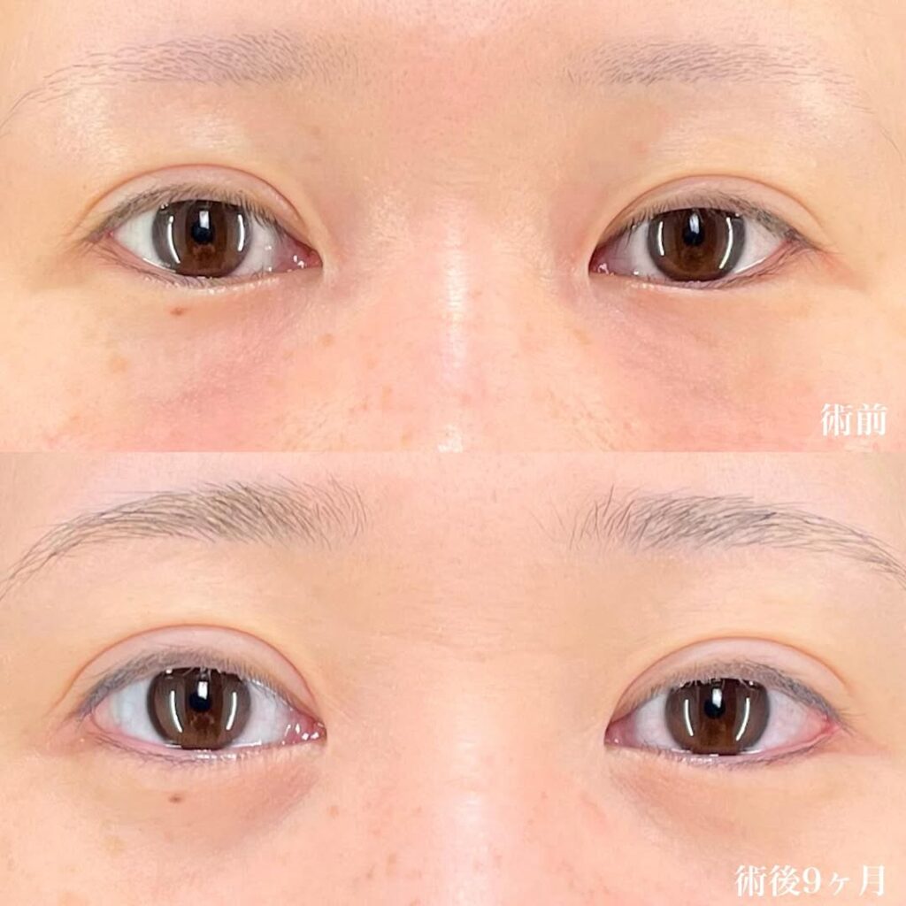 白目拡大術 症例