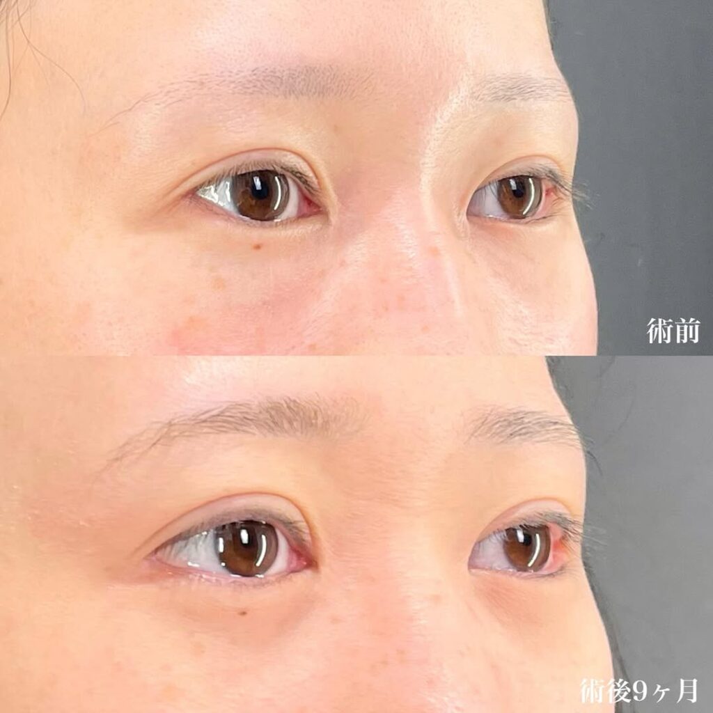 白目拡大術 症例
