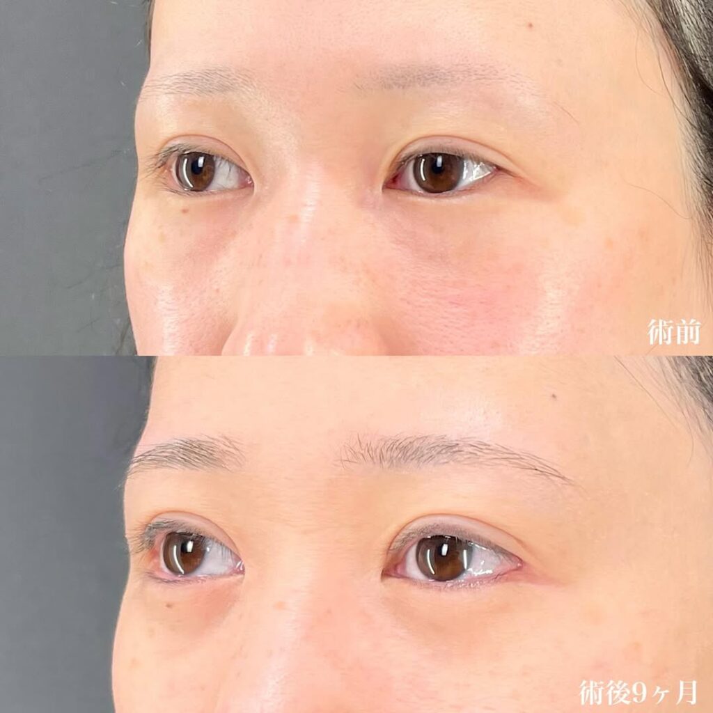 白目拡大術 症例