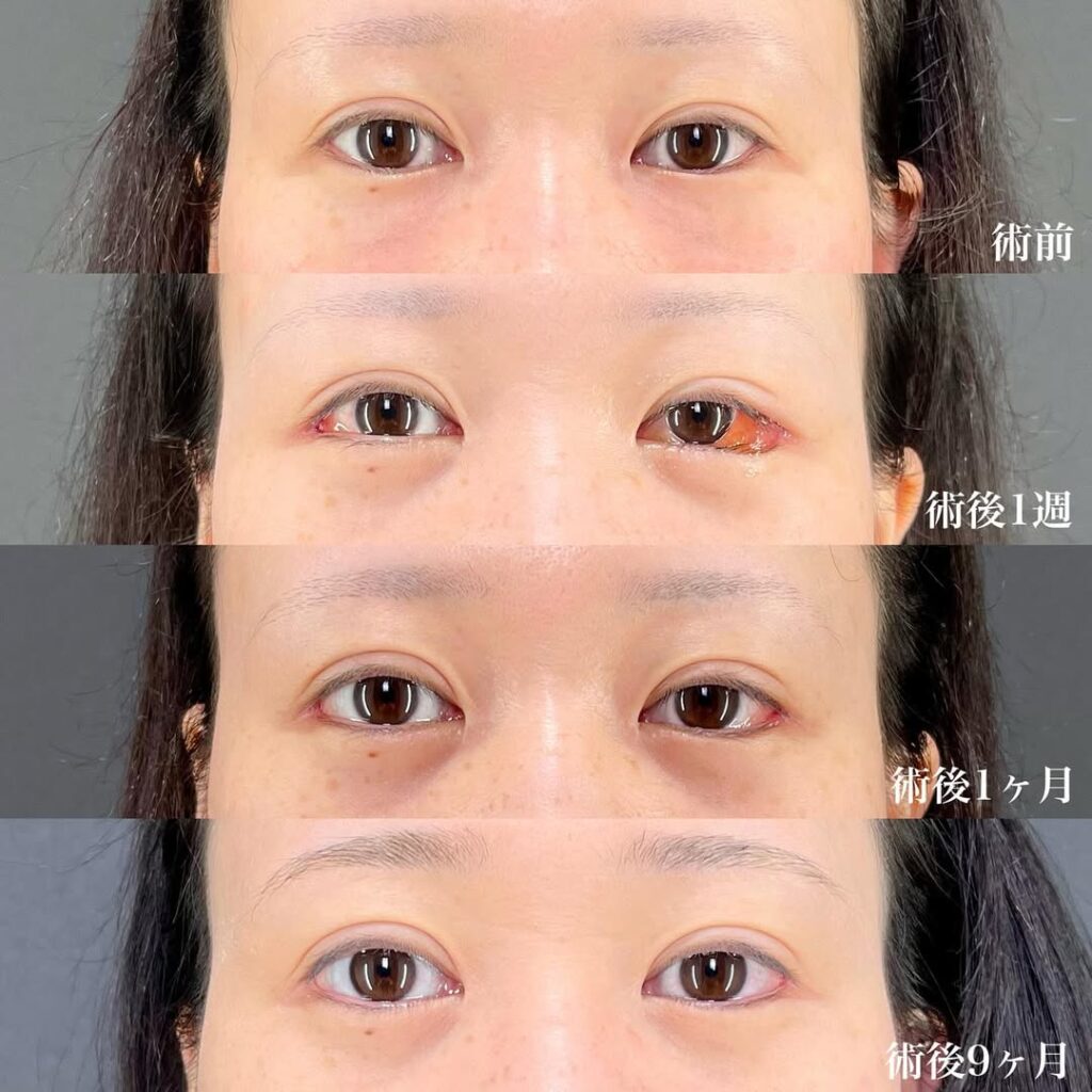 白目拡大術 症例