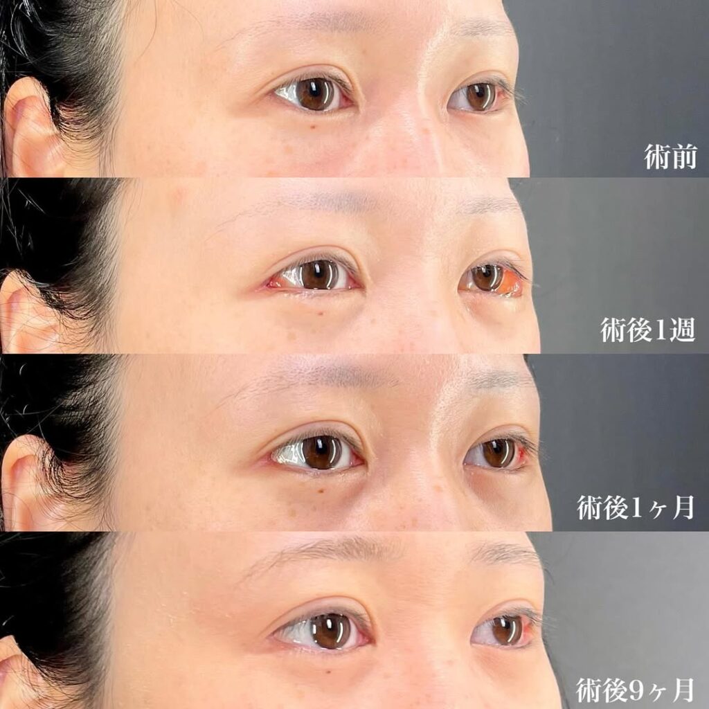 白目拡大術 症例