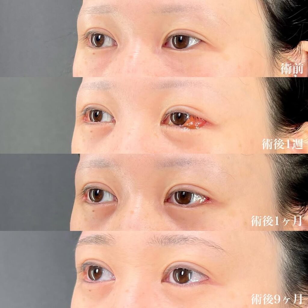 白目拡大術 症例