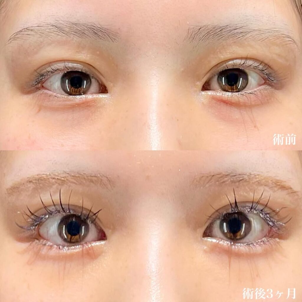 白目拡大術 裏ハムラ 症例