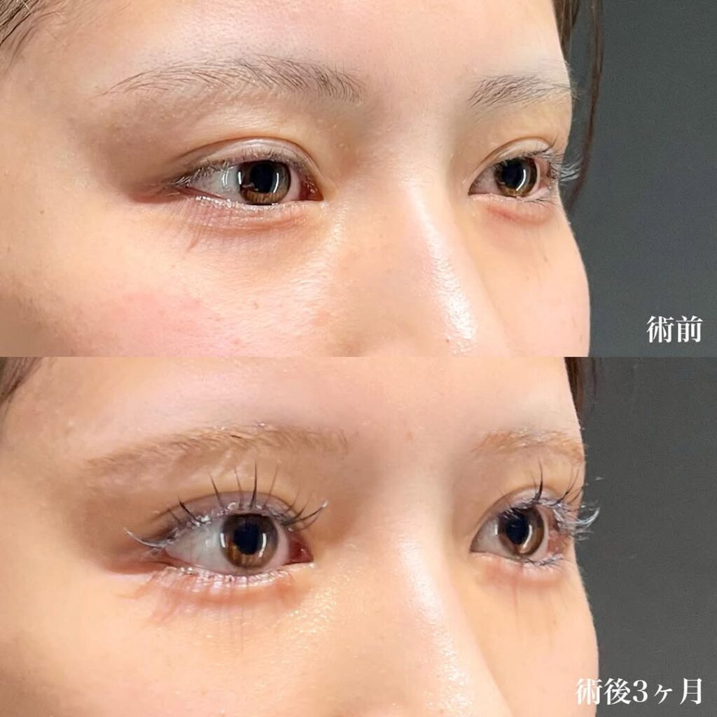 白目拡大術 裏ハムラ 症例