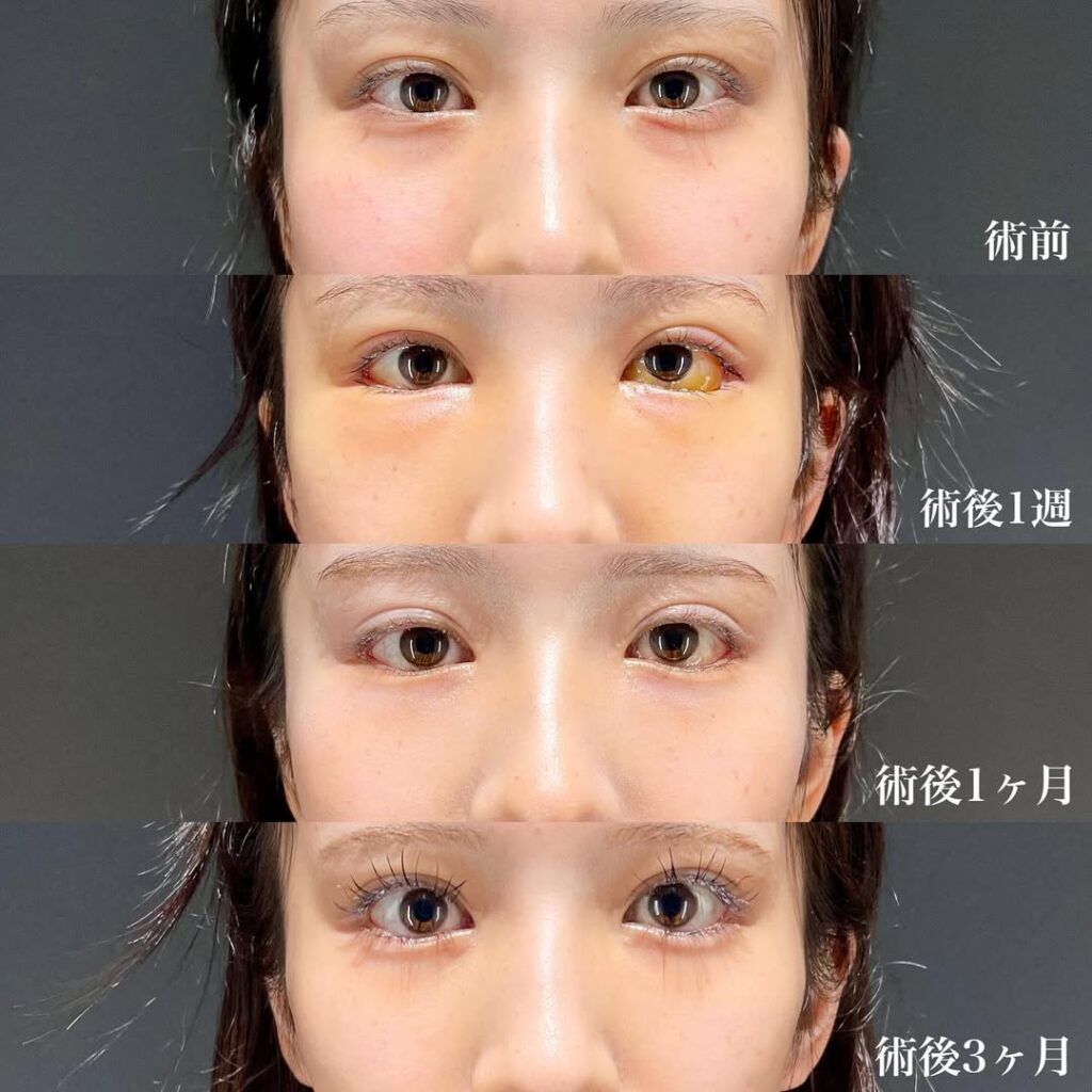 白目拡大術 裏ハムラ 症例