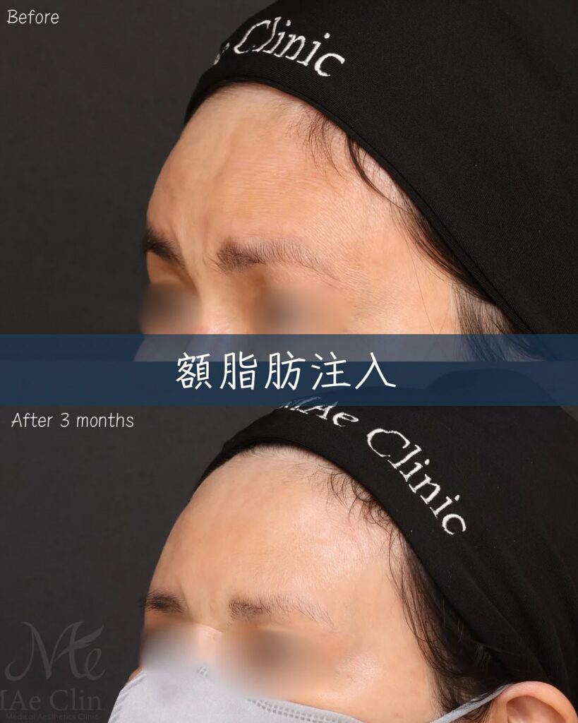 額脂肪注入 症例