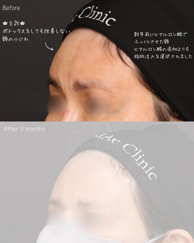 額脂肪注入 症例