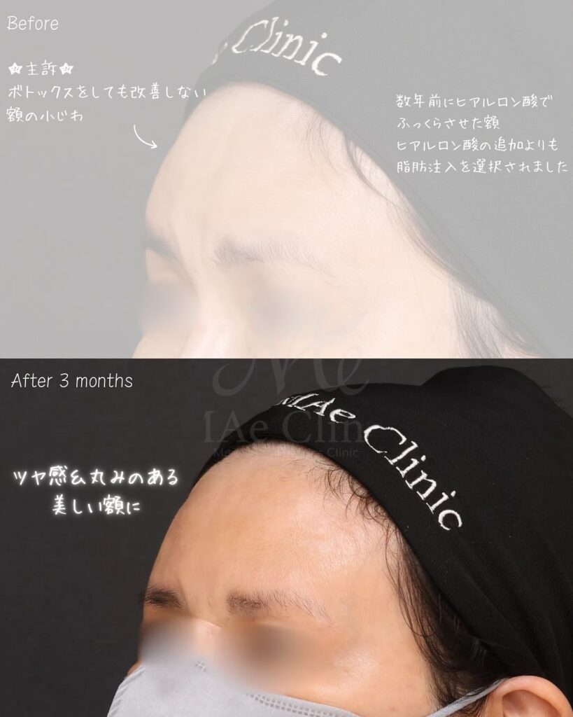 額脂肪注入 症例