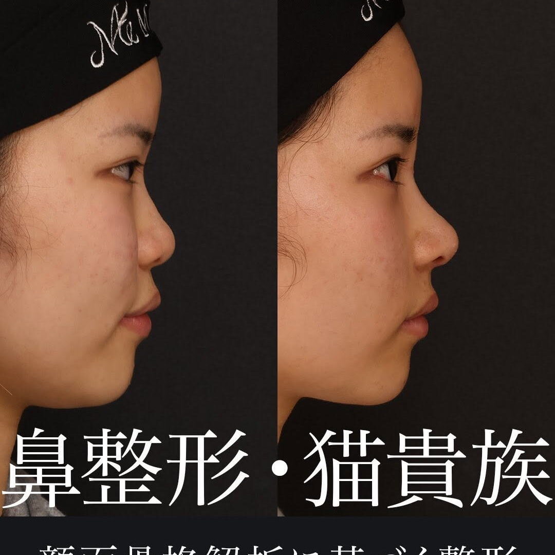 鼻整形＋猫貴族手術】中顔面の立体感を自然に引き出す複合施術｜術後2