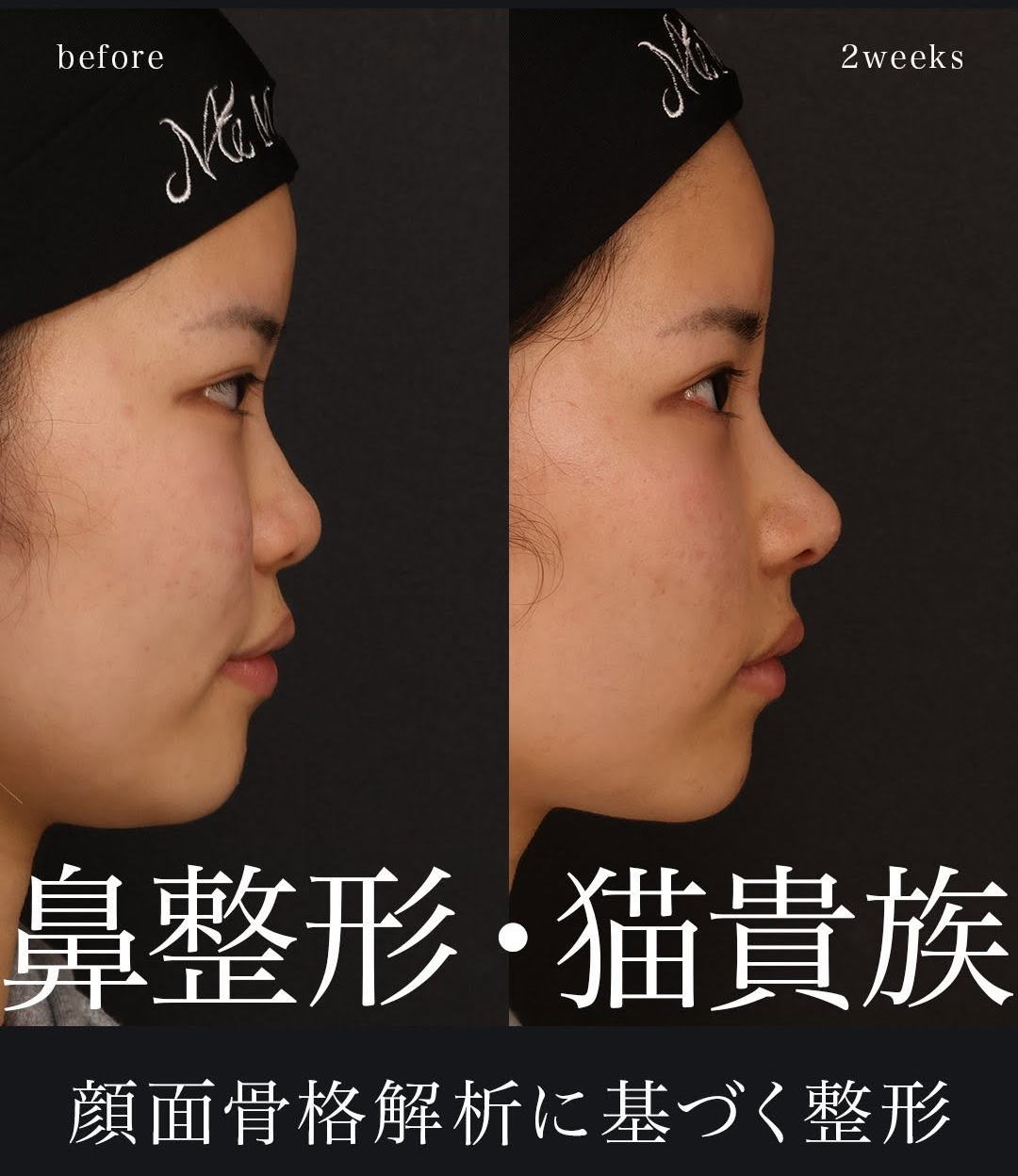 鼻整形＋猫貴族手術】中顔面の立体感を自然に引き出す複合施術｜術後2