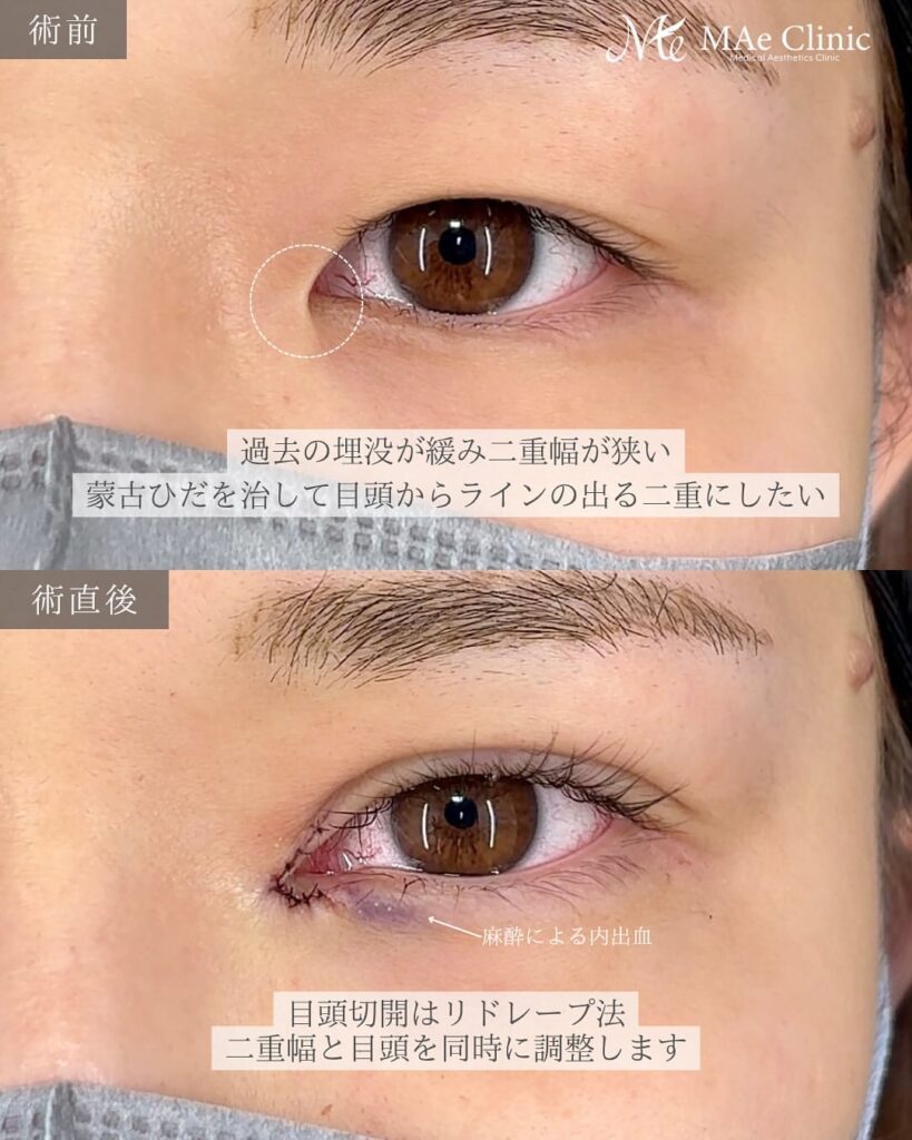 目頭切開 埋没 症例