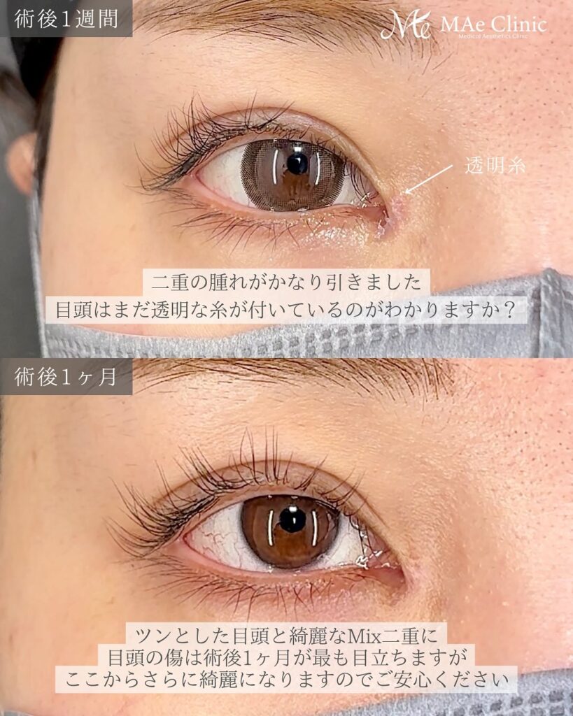 目頭切開 症例