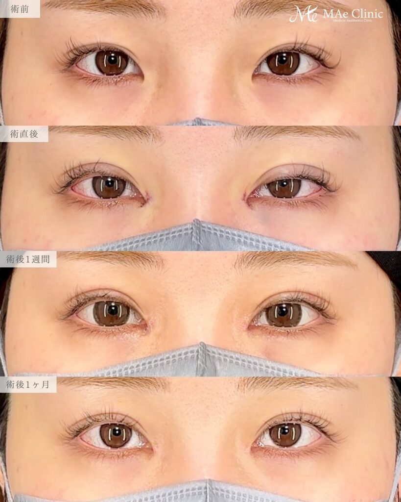 目頭切開 症例