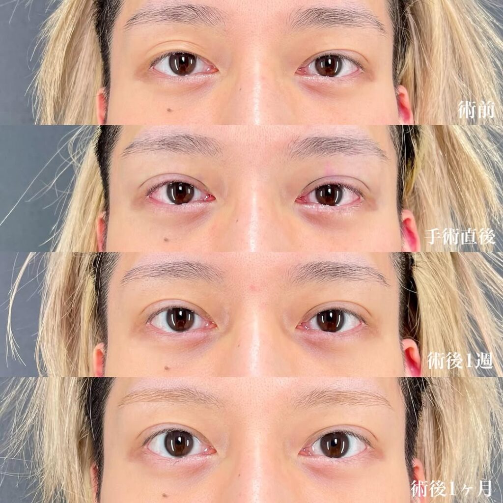 埋没二重 症例