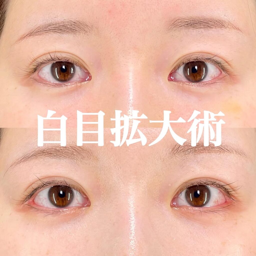 白目拡大術
