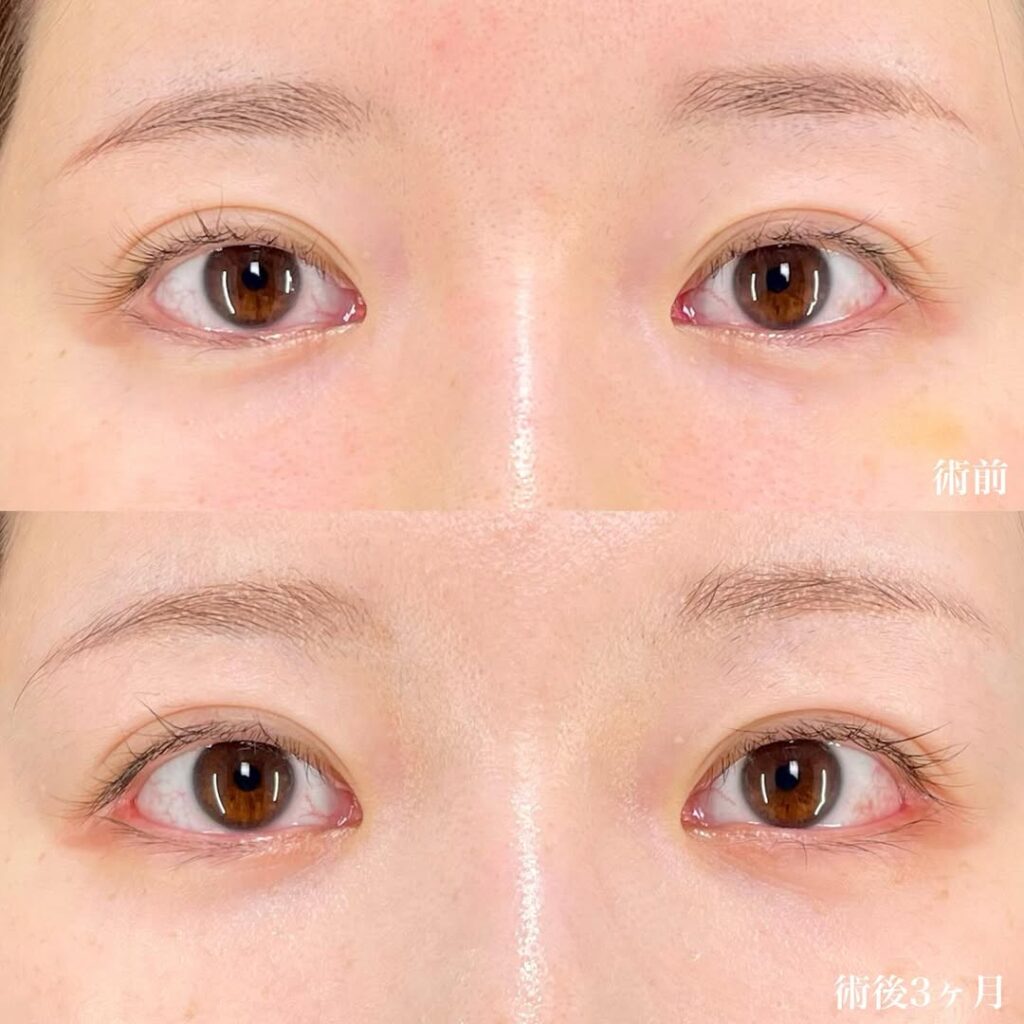 白目拡大術