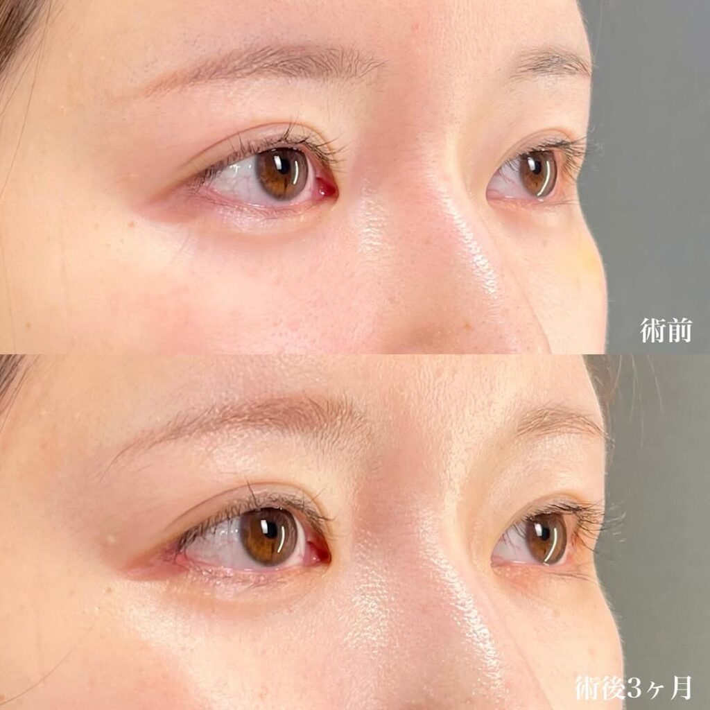 白目拡大術