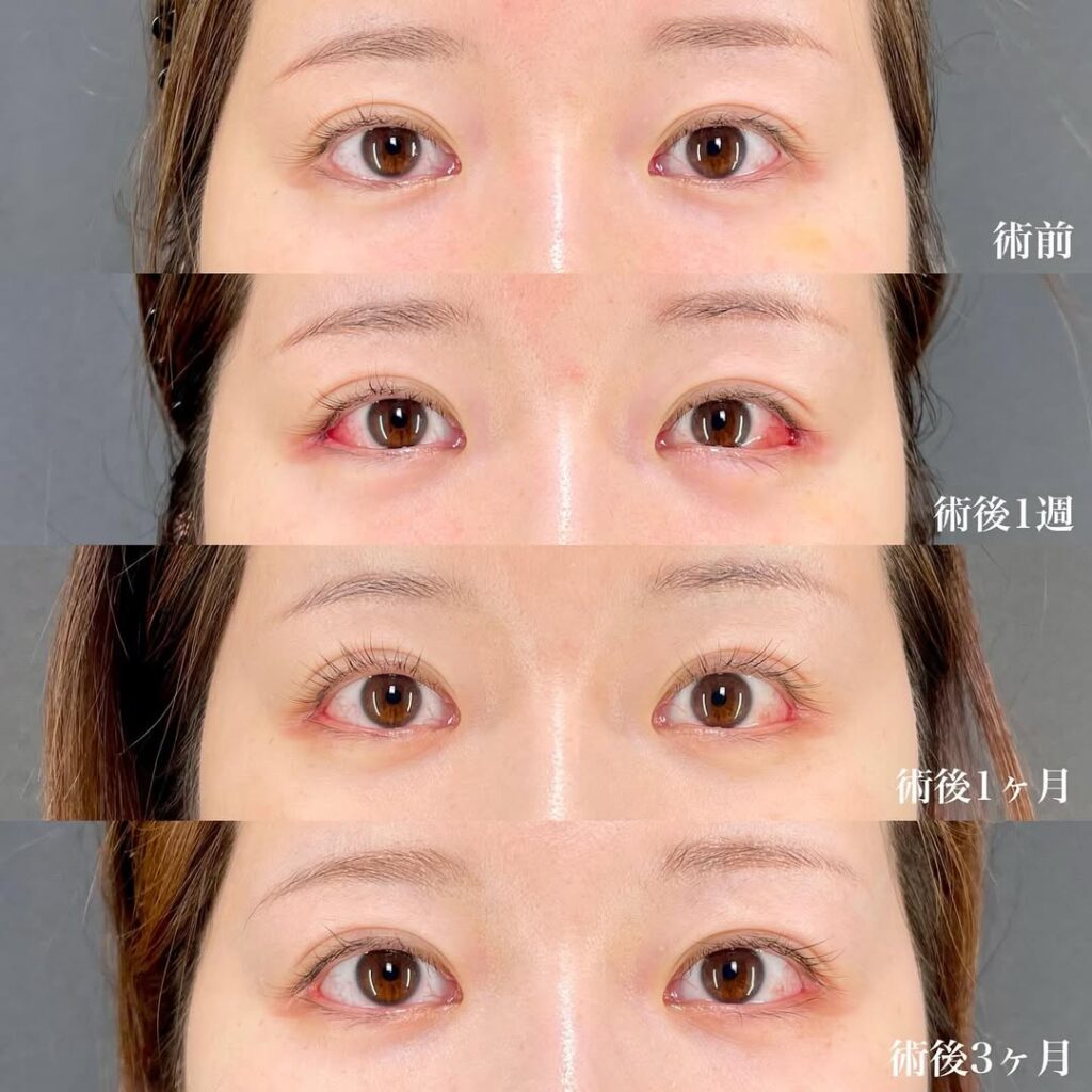 白目拡大術