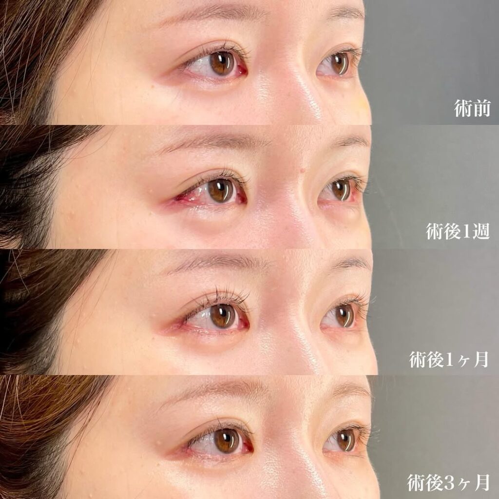 白目拡大術