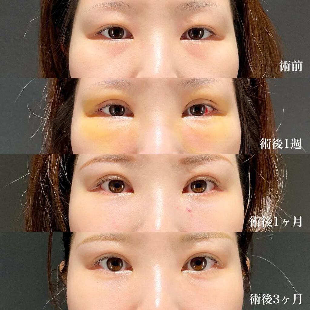 埋没二重(裏留め) 上まぶたの脂肪取り(マイクロリポサクション) 裏ハムラ 症例