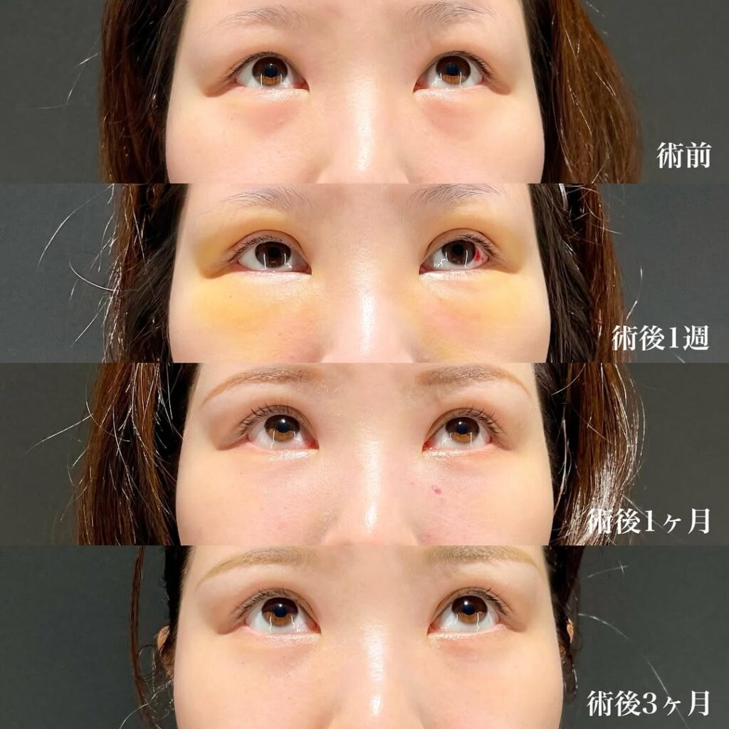 埋没二重(裏留め) 上まぶたの脂肪取り(マイクロリポサクション) 裏ハムラ 症例