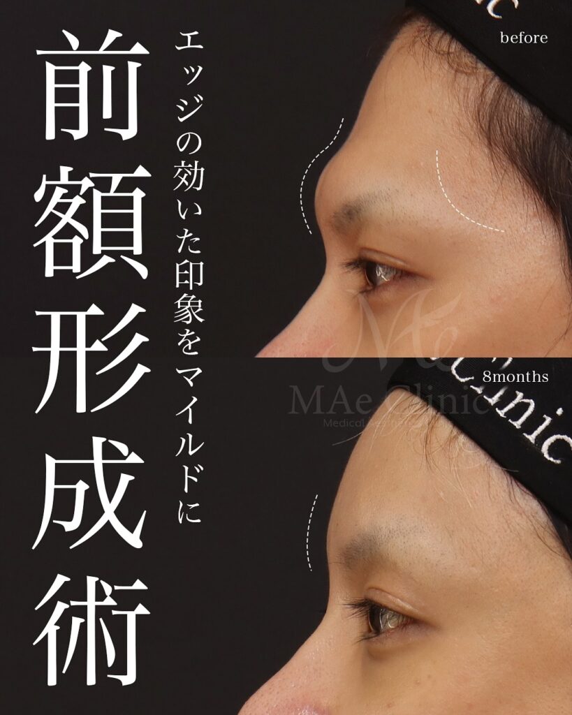 前額形成(前頭洞セットバック)
前額リフト
症例