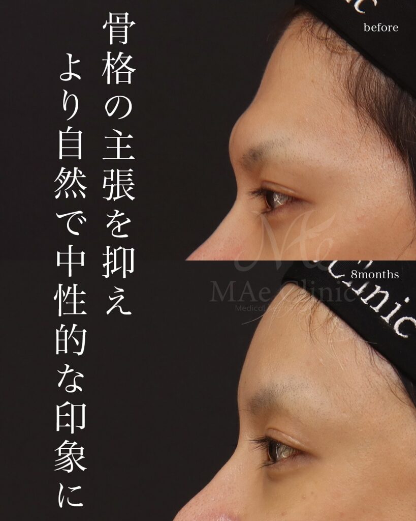 前額形成(前頭洞セットバック) 前額リフト 症例